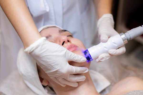 Pico Laser Treatment: Fast Facts You Should Know